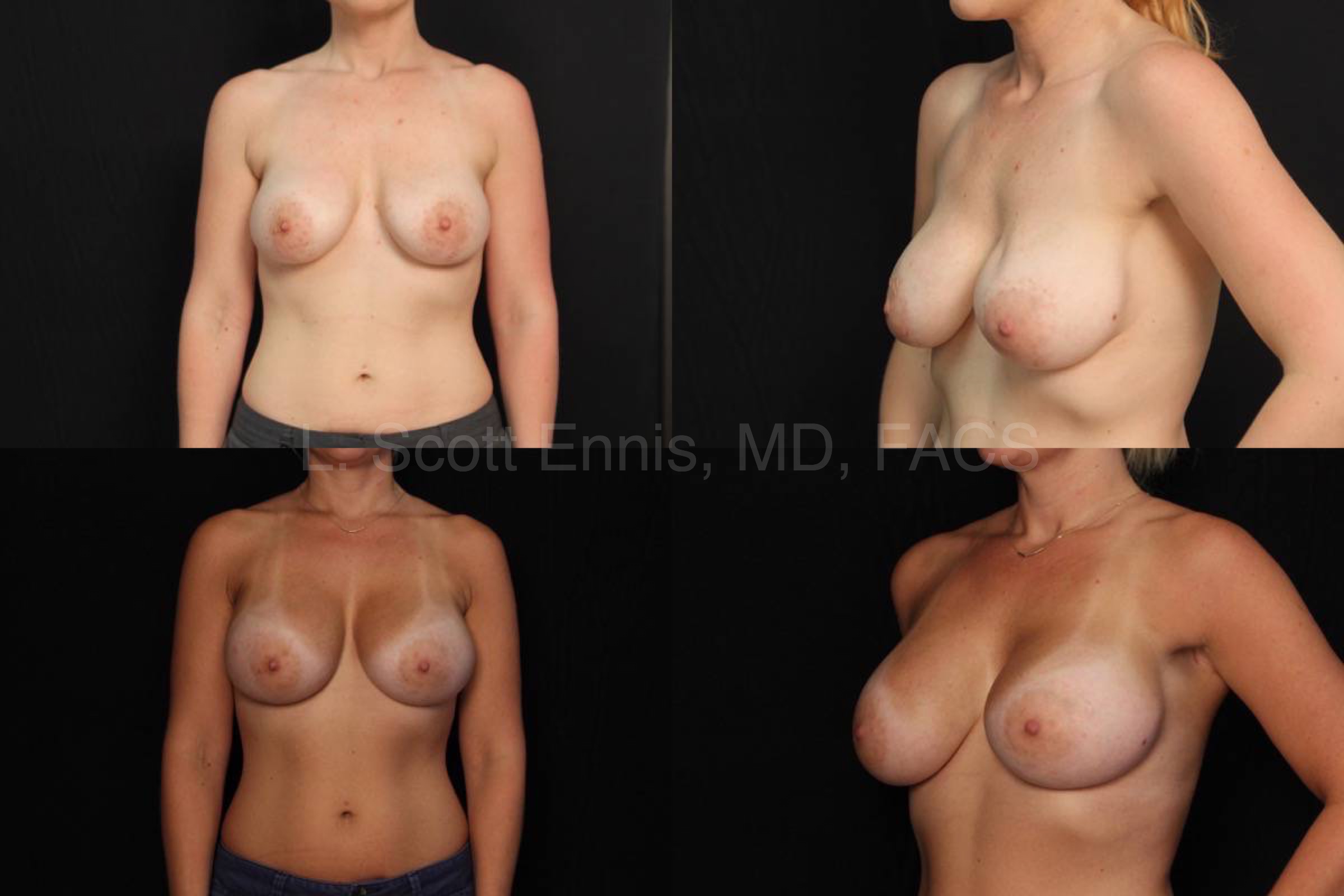 Breast Implant Exchange Bilateral from Saline to Silicone to improve rippling L600 R650 Before and After Ennis Plastic Surgery Palm Beach Boca Raton Destin Miami Fort Lauderdale