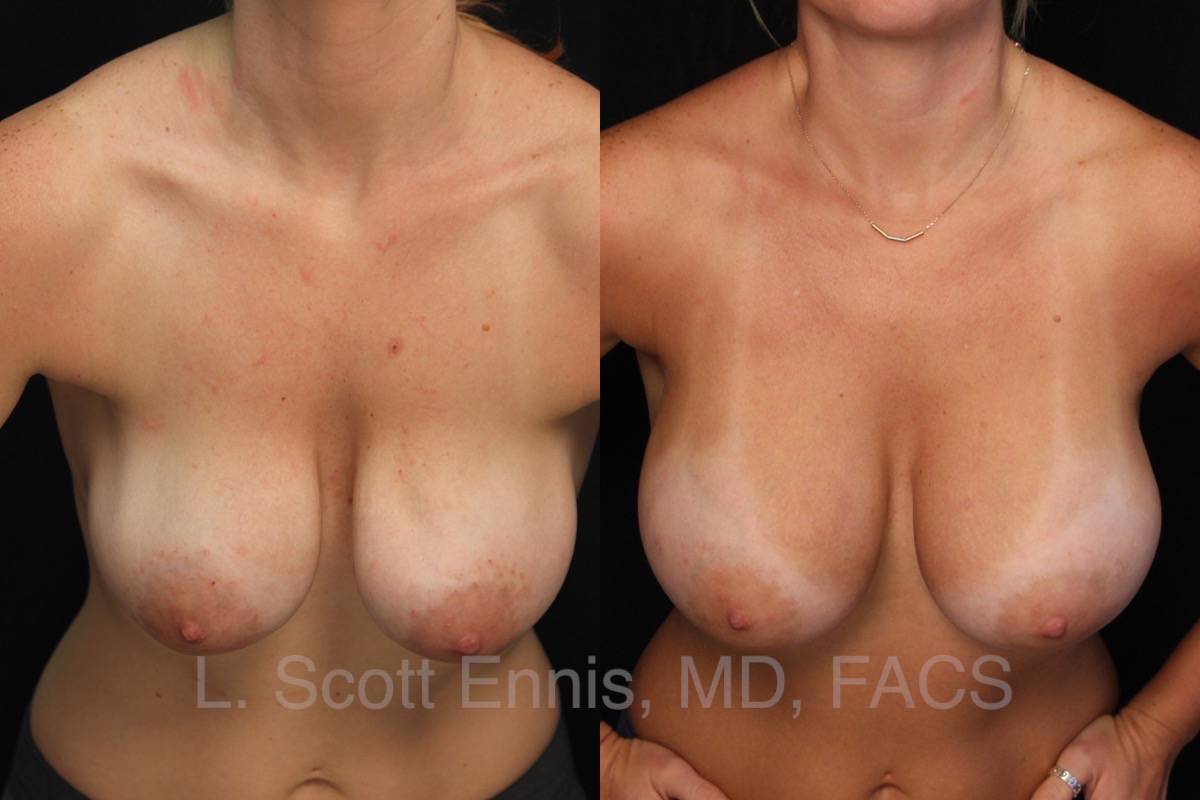 Breast Implant Exchange from saline to silicone to correct rippling - Before and After Ennis Plastic Surgery Palm Beach Boca Raton Destin Miami Fort Lauderdale