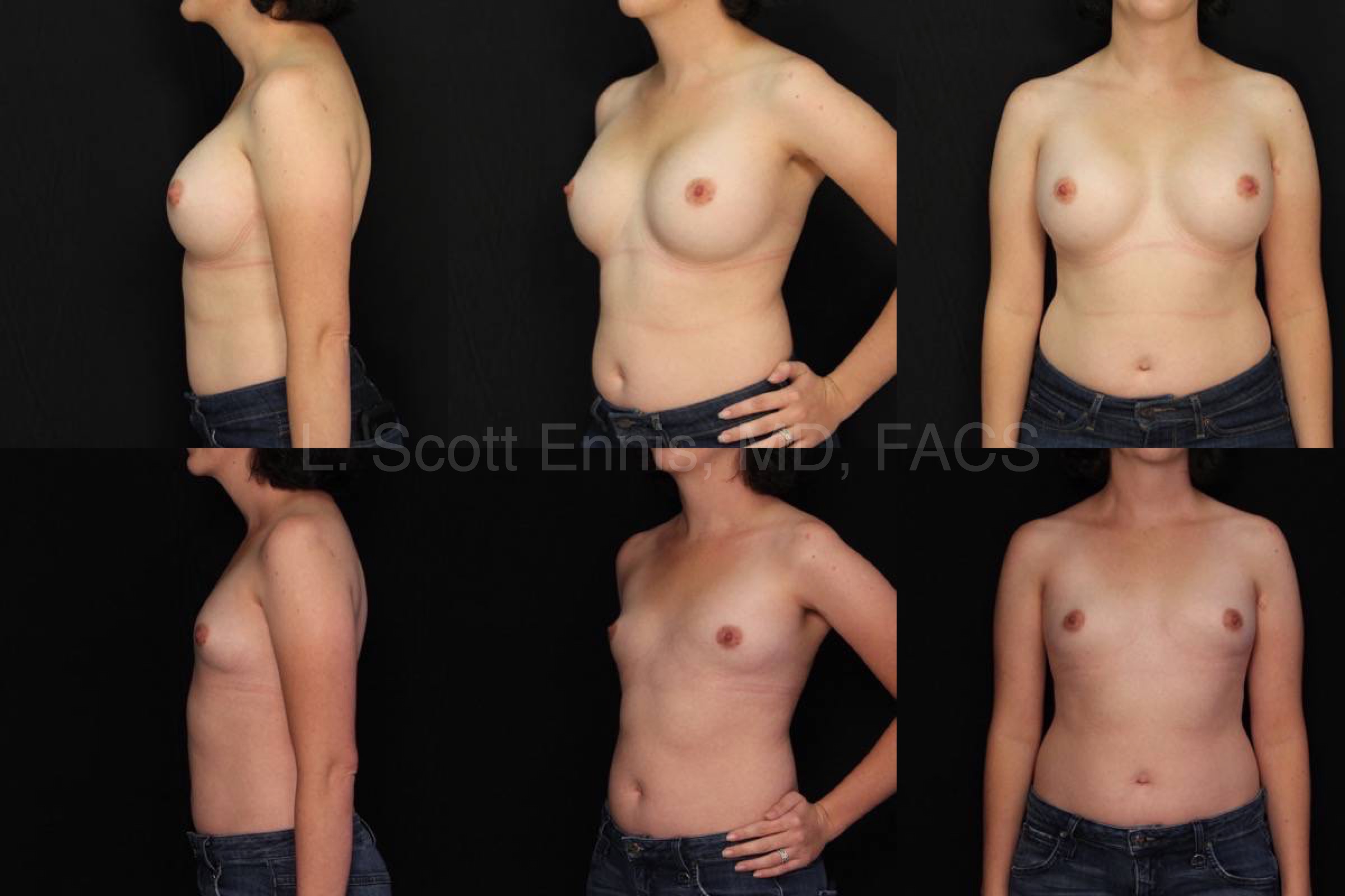 Breast Implant Removal without Replacement bilateral Before and After Ennis Plastic Surgery Palm Beach Boca Raton Destin Miami Fort Lauderdale