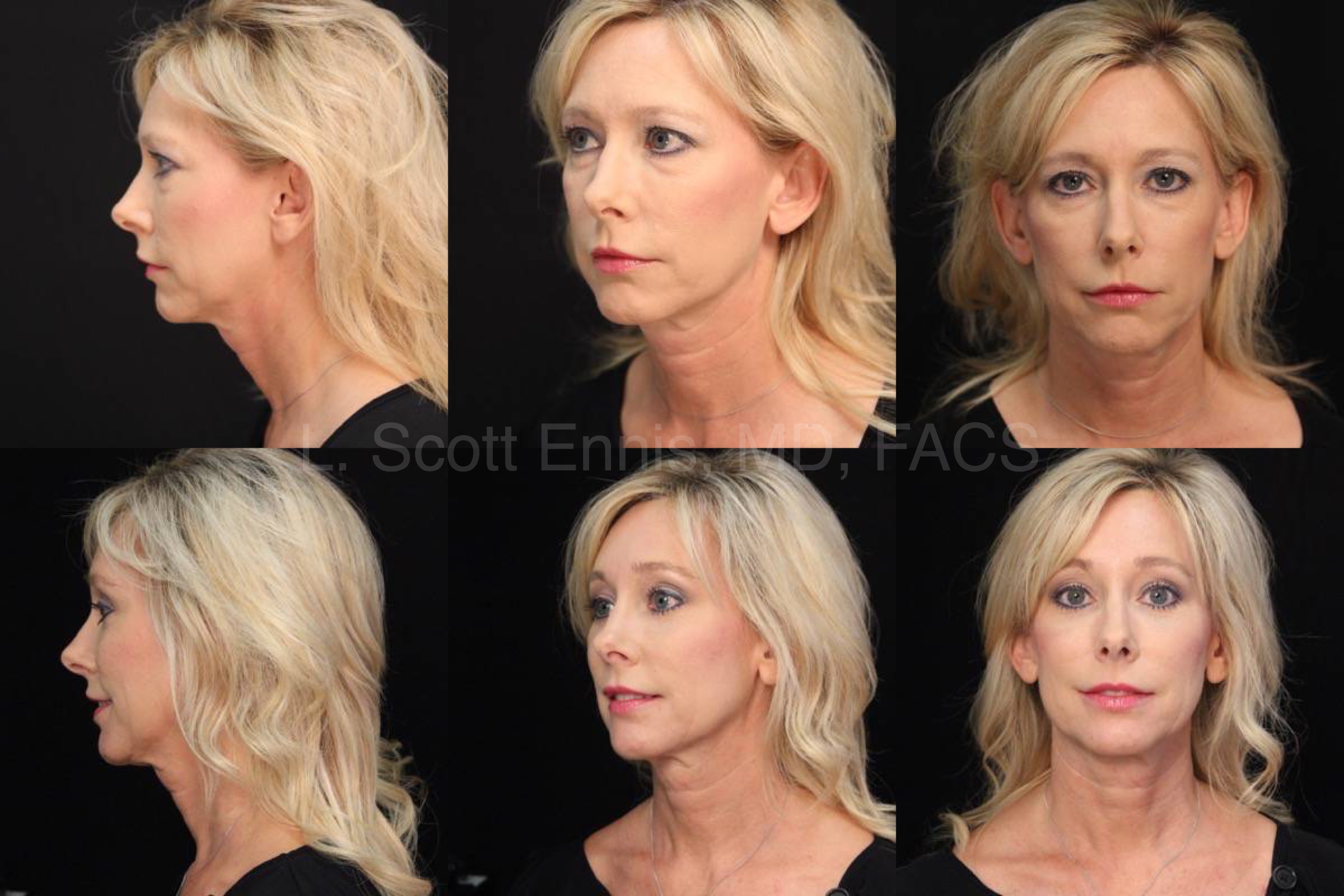 Brow Lift Endoscopic Brow lift_ lower bleph_ Obagi TCA Blue Peel 47yof Before and After Ennis Plastic Surgery Palm Beach Boca Raton Destin Miami Fort Lauderdale