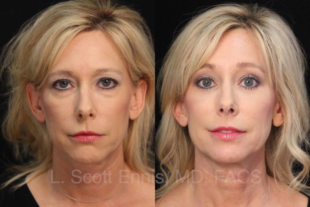 Browlift & Facelift