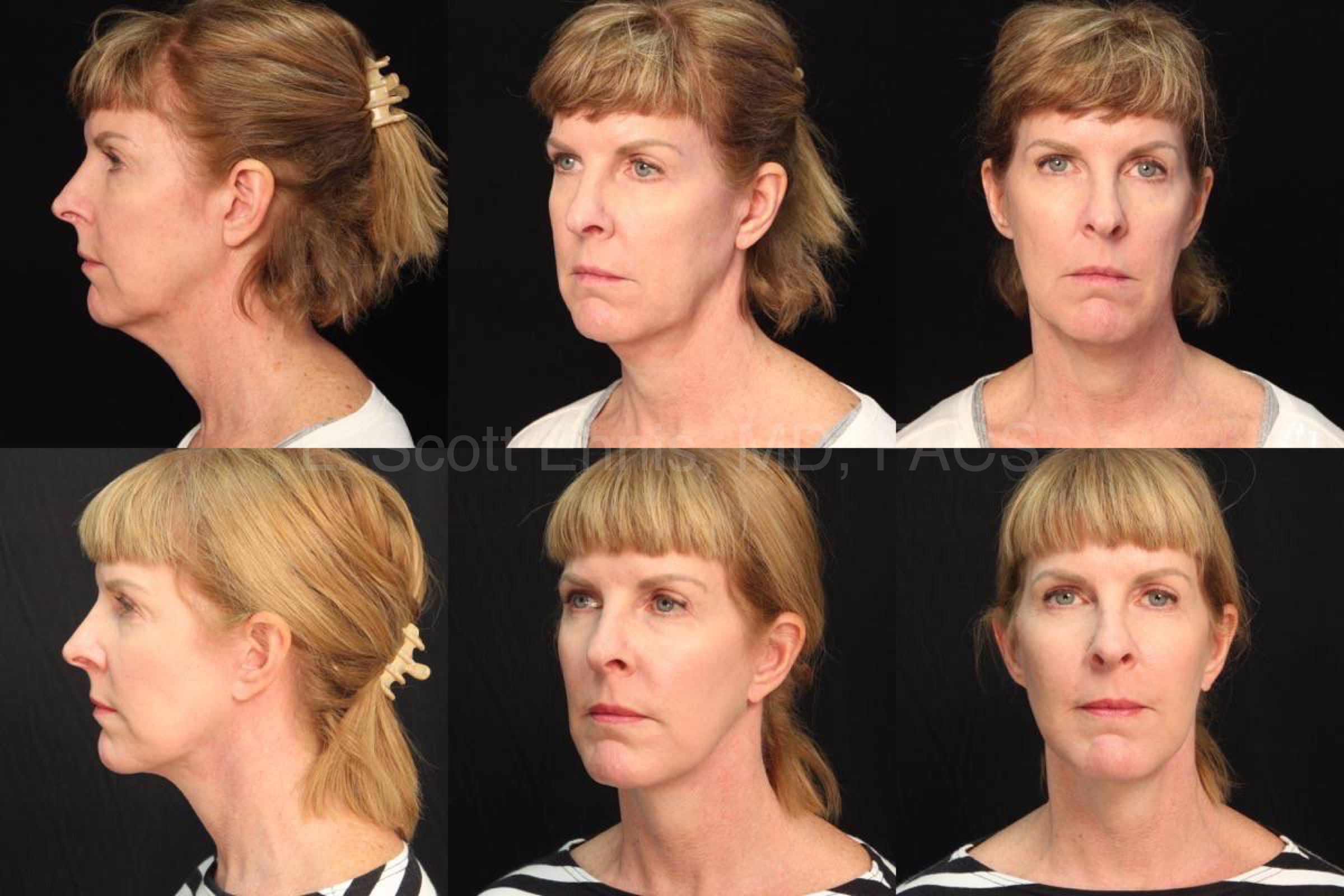 Facelift Exc of Buccal fat pads 55yof Before and After Ennis Plastic Surgery Palm Beach Boca Raton Destin Miami Fort Lauderdale