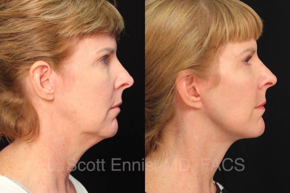 Facelift Exc of Buccal fat pads 55yof Before and After Ennis Plastic Surgery Palm Beach Boca Raton Destin Miami Fort Lauderdale