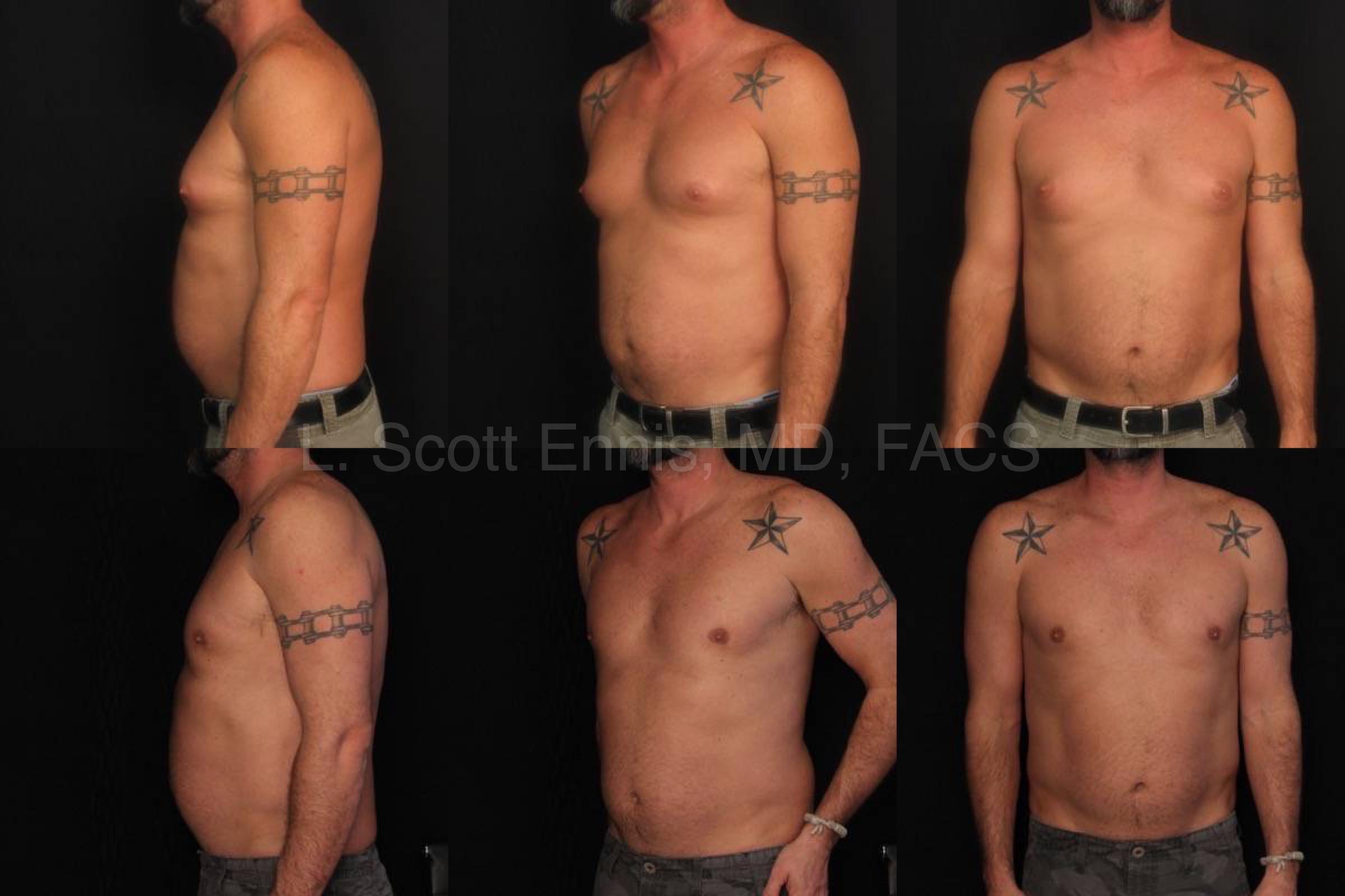 Gynecomastia Liposuction of Chest Before and After Ennis Plastic Surgery Palm Beach Boca Raton Destin Miami Fort Lauderdale