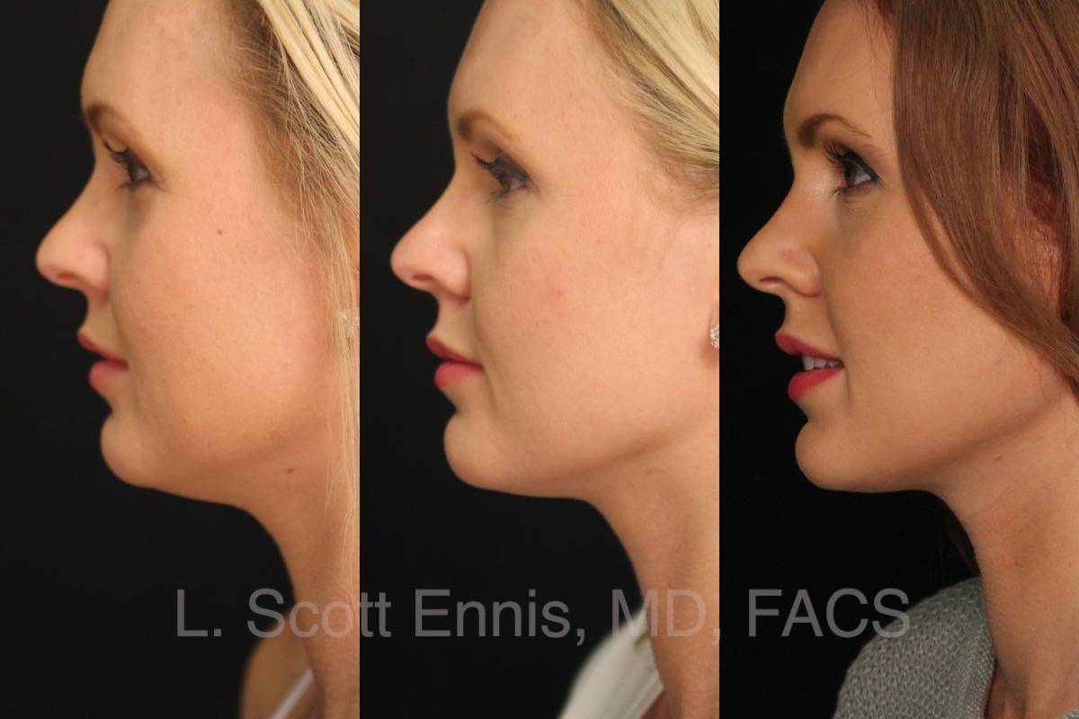 Kybella to the neck 32 yof Before and After Ennis Plastic Surgery Palm Beach Boca Raton Destin Miami Fort Lauderdale