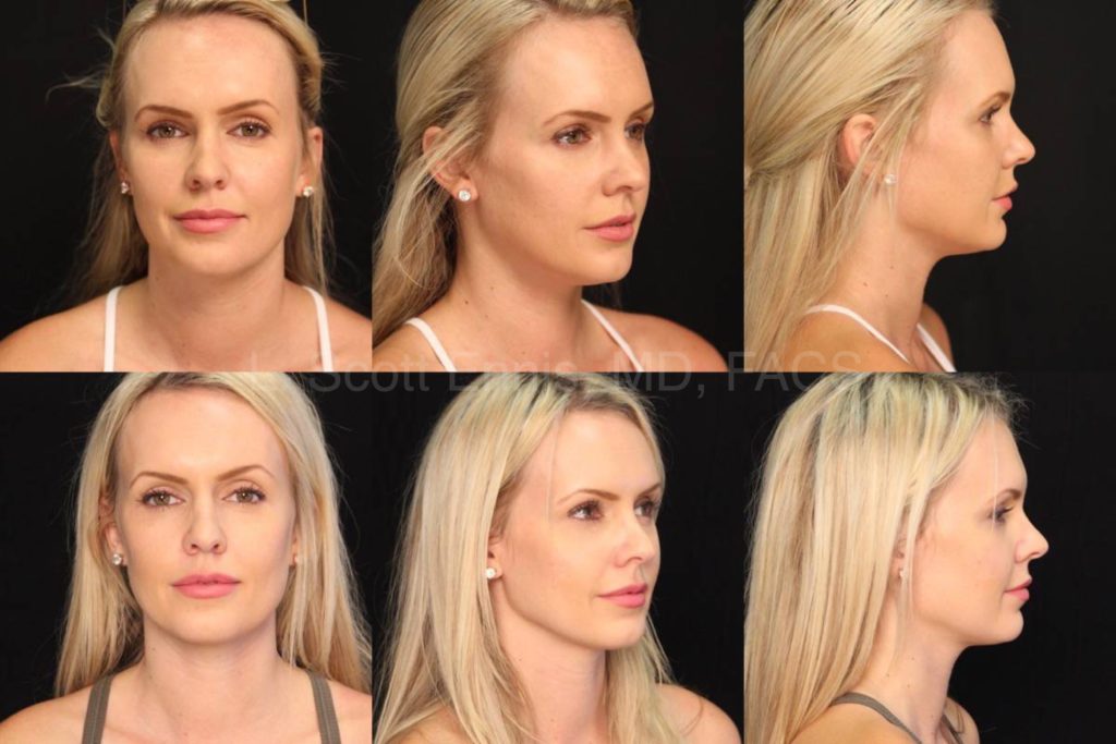 Kybella to the neck 32 yof Before and After Ennis Plastic Surgery Palm Beach Boca Raton Destin Miami 13848 (3)