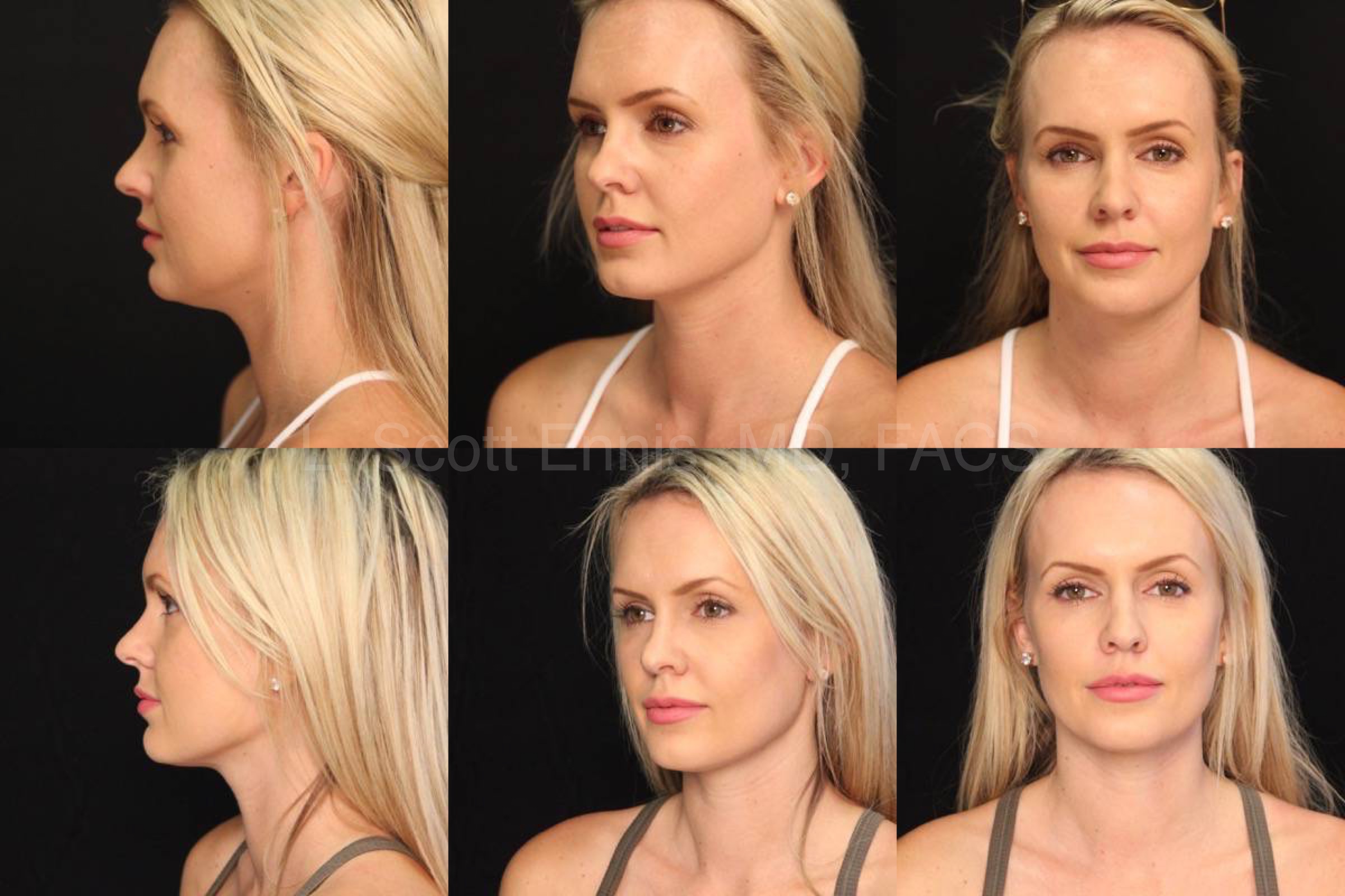 Kybella to the neck 32 yof Before and After Ennis Plastic Surgery Palm Beach Boca Raton Destin Miami Fort Lauderdale