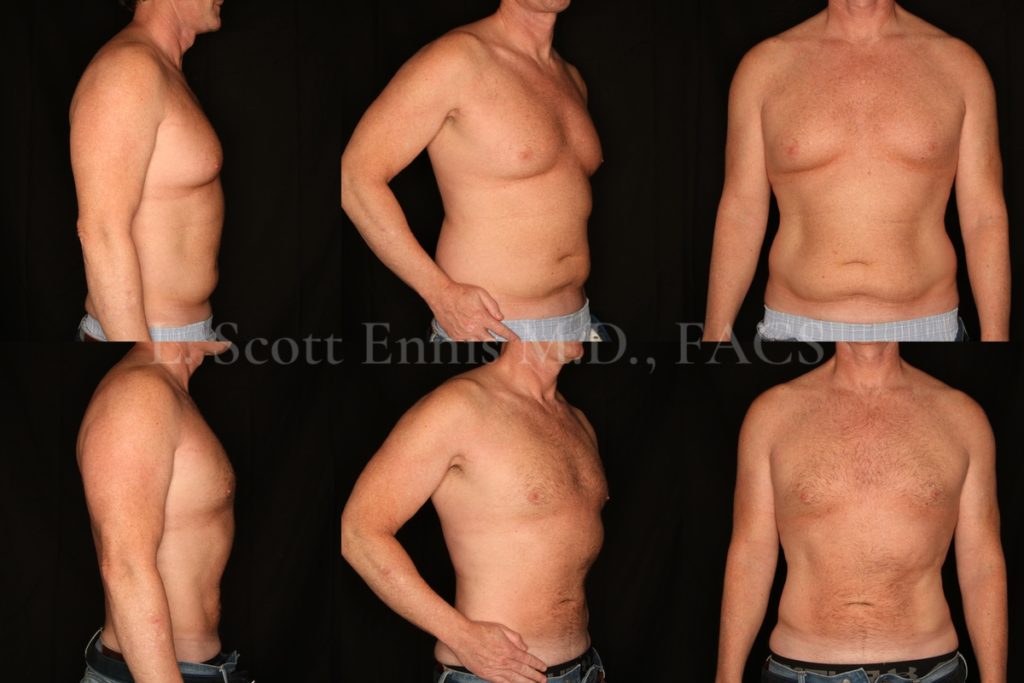Liposuction for Men Before and After