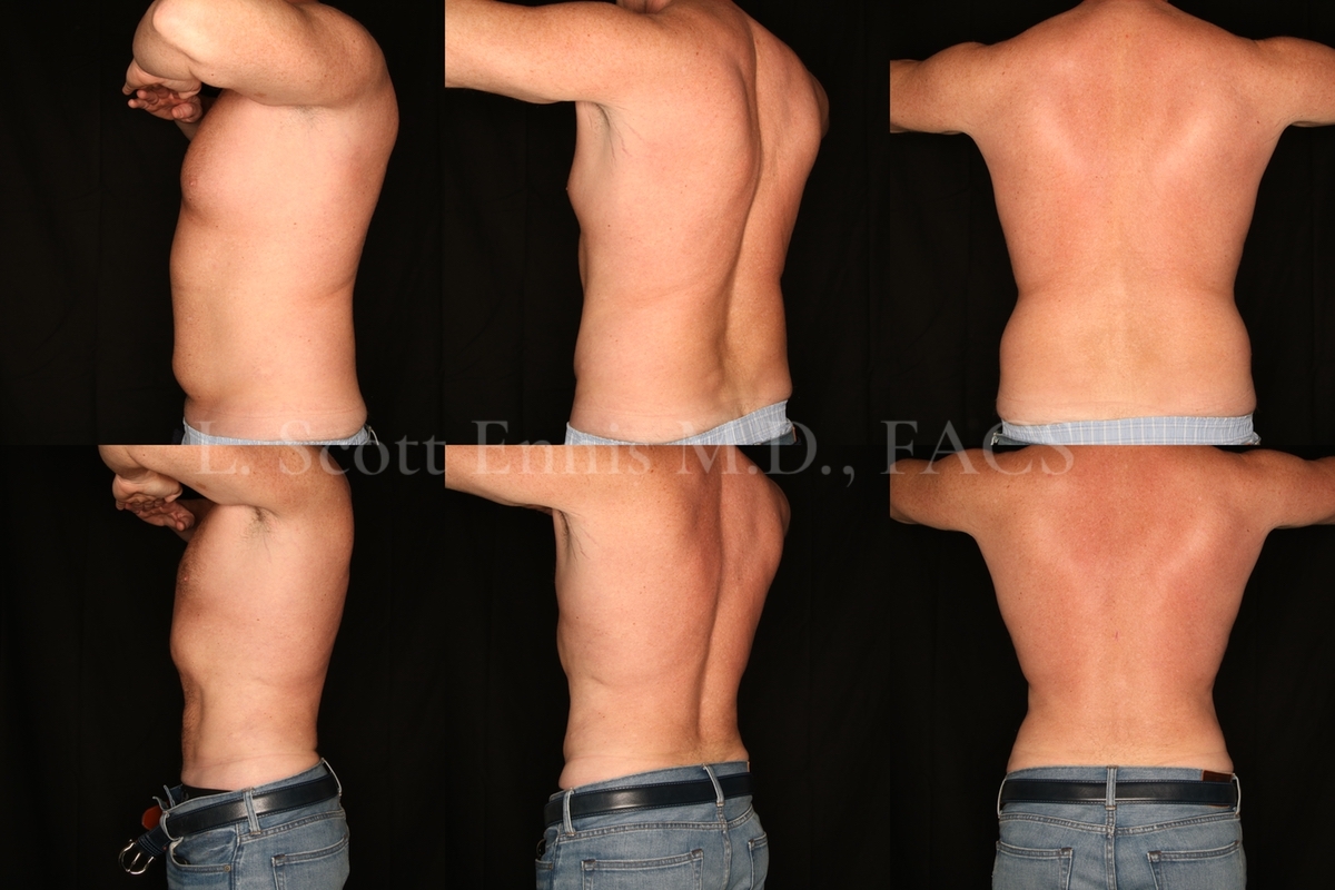 Liposuction for Men Before and After at Ennis Plastic Surgery 45YOM liposuction of the Abdomen and hips-back Destin Maimi Fort Lauderdale Palm Beach Boca Raton