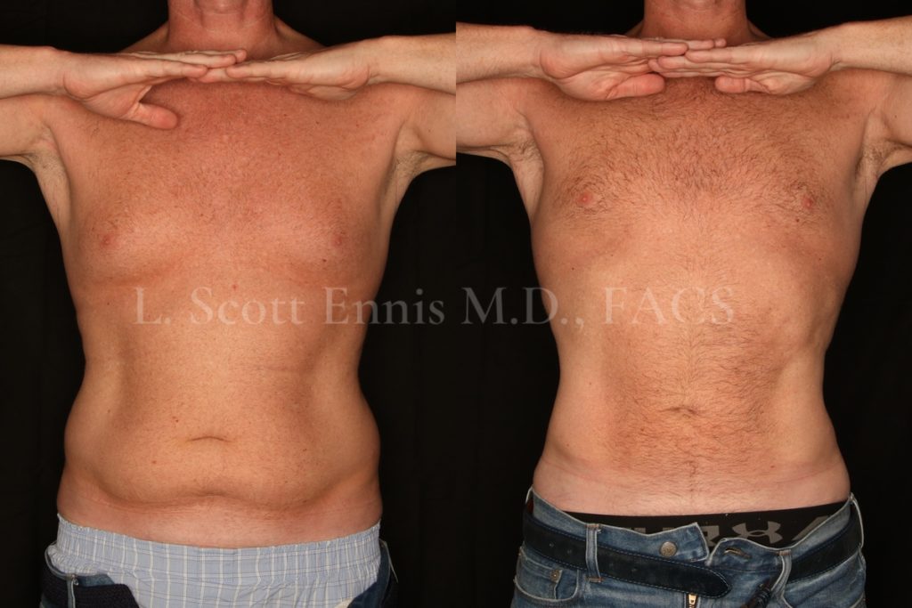 Liposuction for Men Before and After