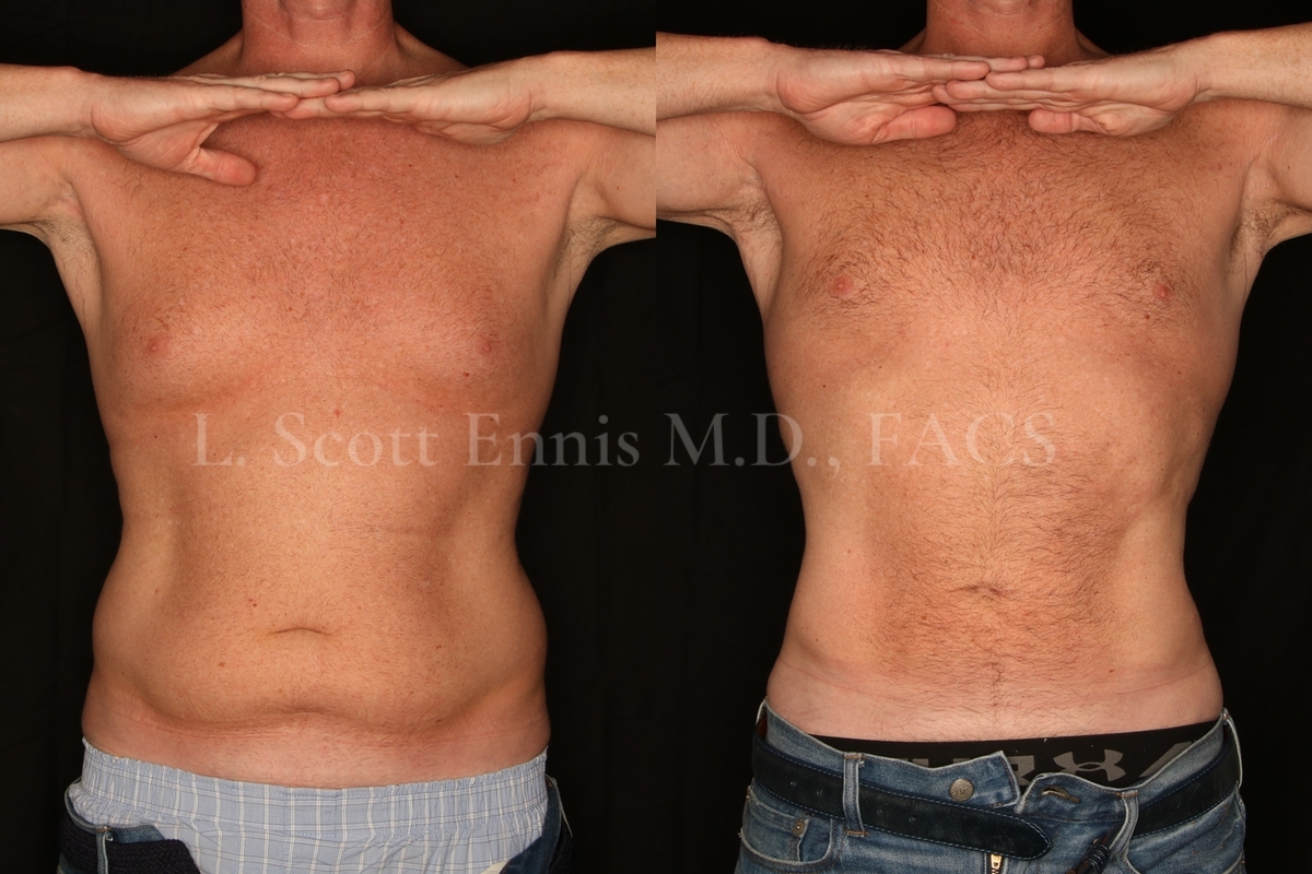 Liposuction for Men Before and After at Ennis Plastic Surgery 45YOM liposuction of the Abdomen and hips-back Destin Maimi Fort Lauderdale Palm Beach Boca Raton