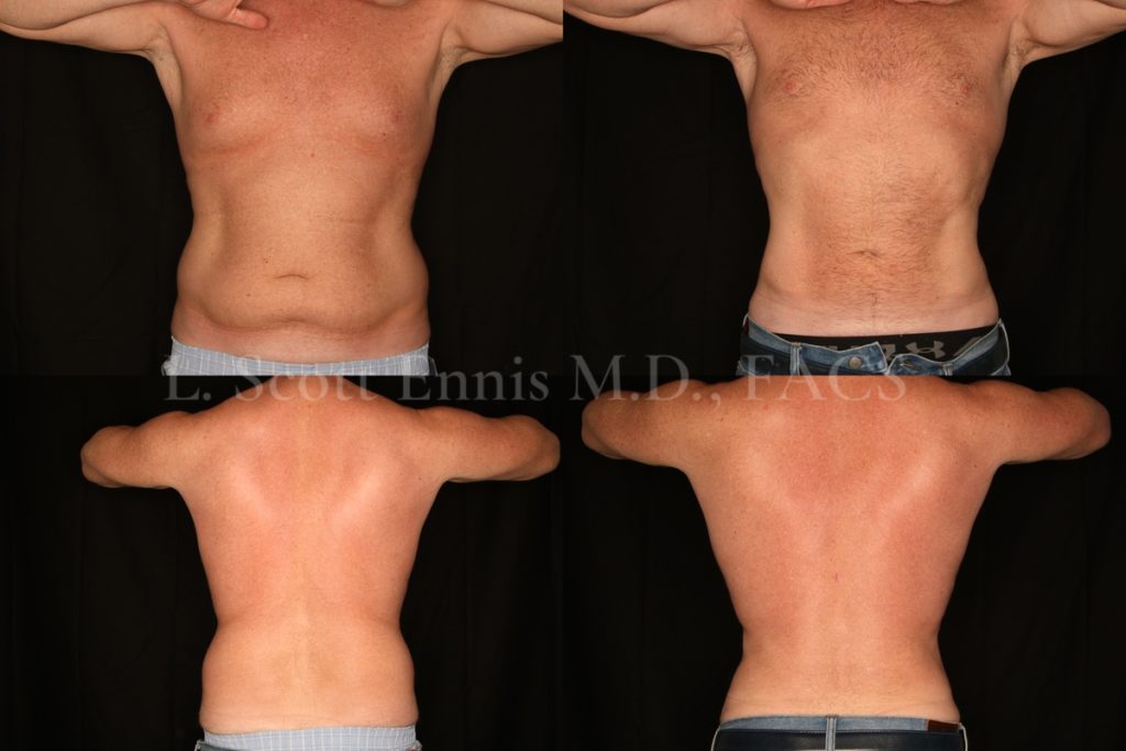 Liposuction for Men Before and After