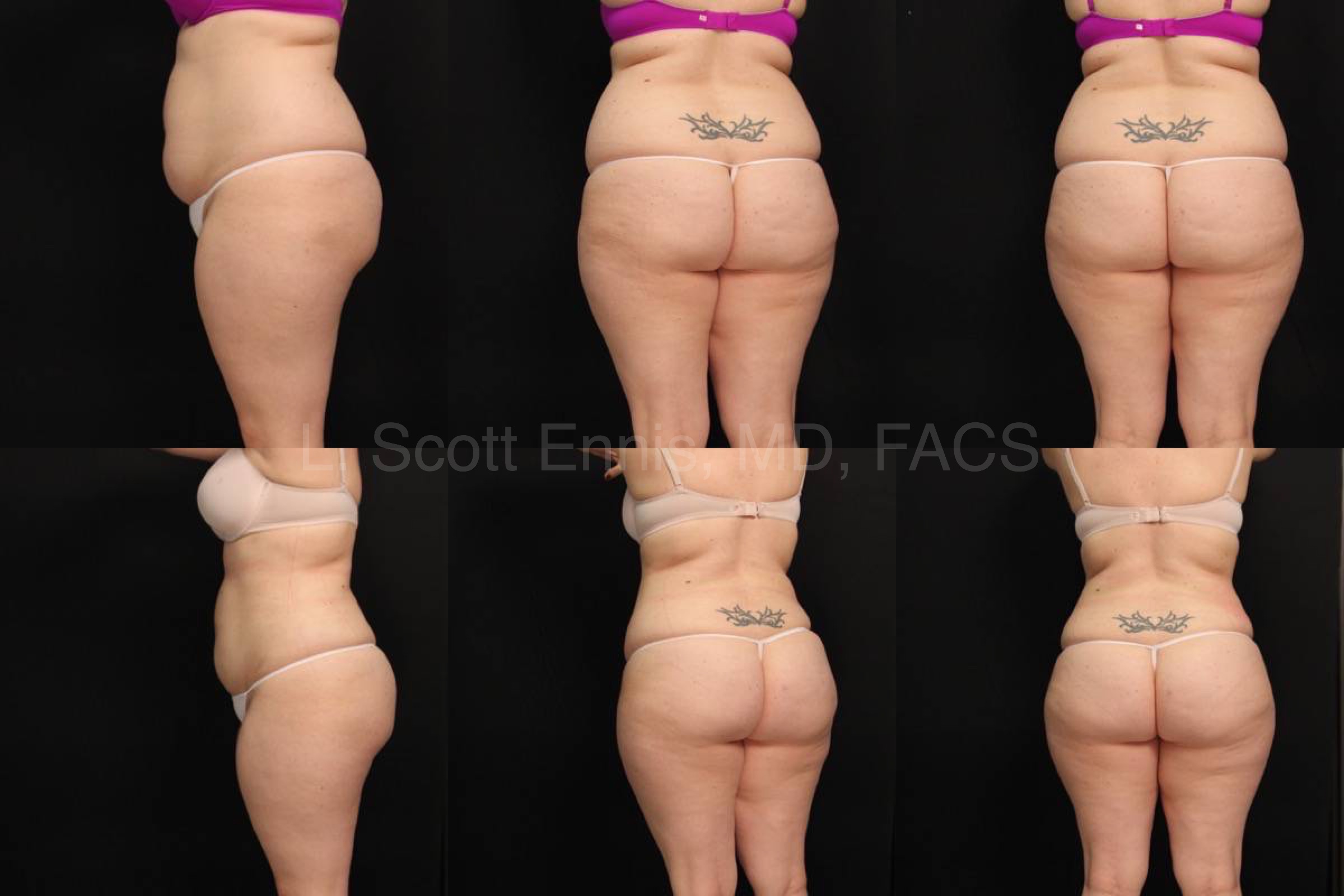 Liposuction of Abdomen and Hips 32yo 5_6_ 190lb Before and After Ennis Plastic Surgery Palm Beach Boca Raton Destin Miami Fort Lauderdale