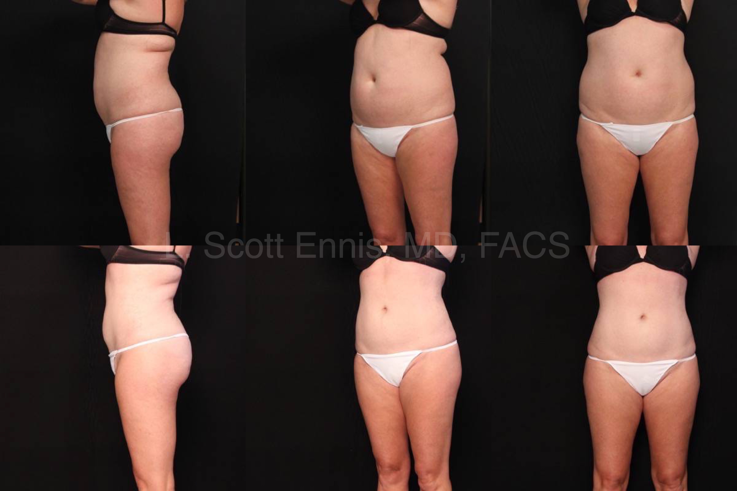 Liposuction of Abdomen and Hips Before and After Ennis Plastic Surgery Palm Beach Boca Raton Destin Miami