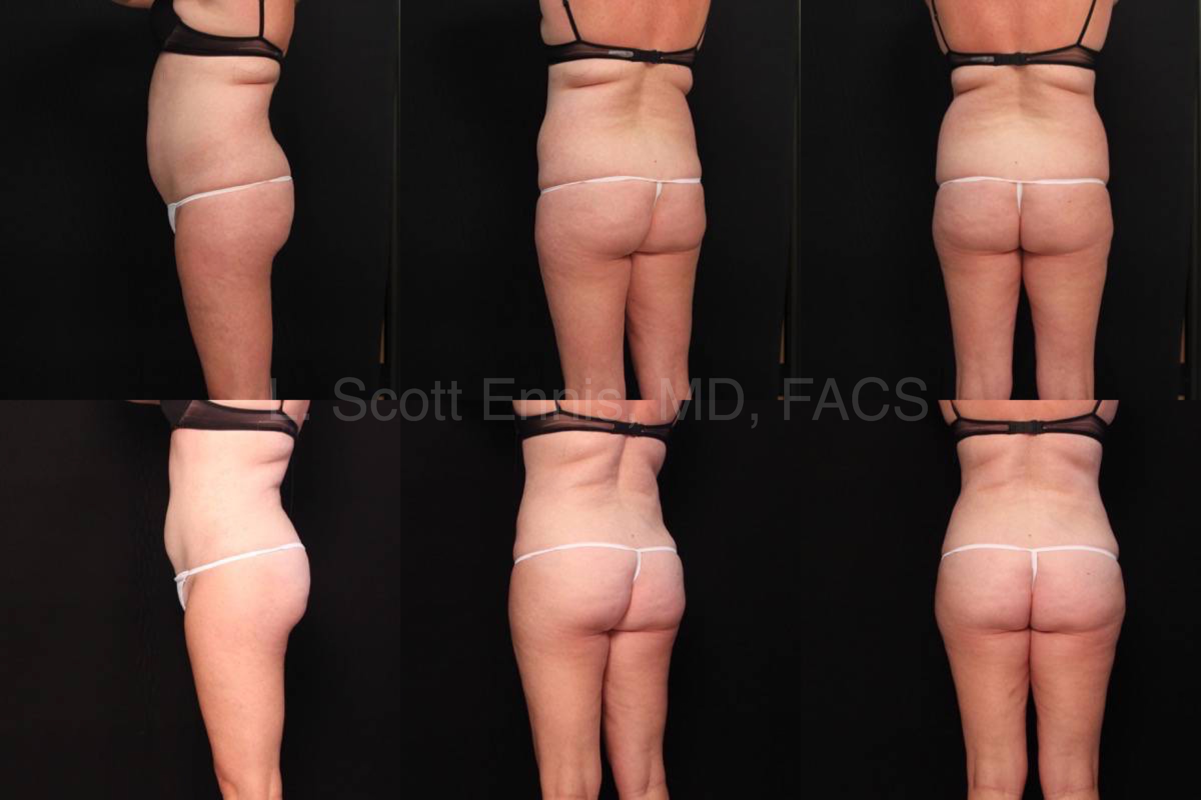 Liposuction of Abdomen and Hips Before and After Ennis Plastic Surgery Palm Beach Boca Raton Destin Miami