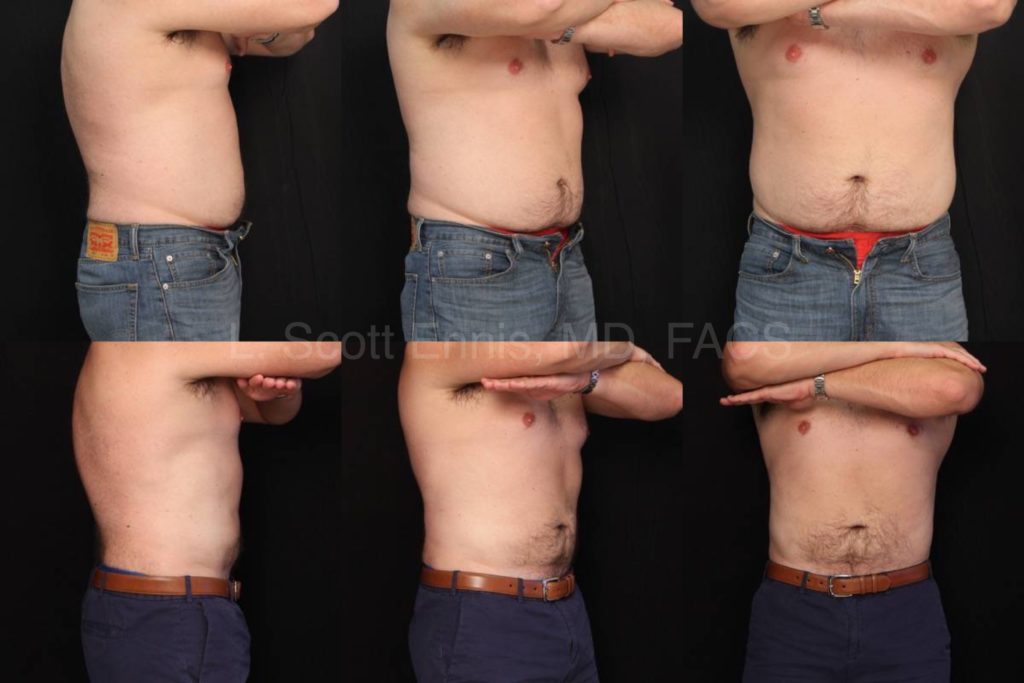 Liposuction of Abdomen_ Hips and Chest 44yo 5_10_ 190lb Before and After Ennis Plastic Surgery Palm Beach Boca Raton Destin Miami 326922