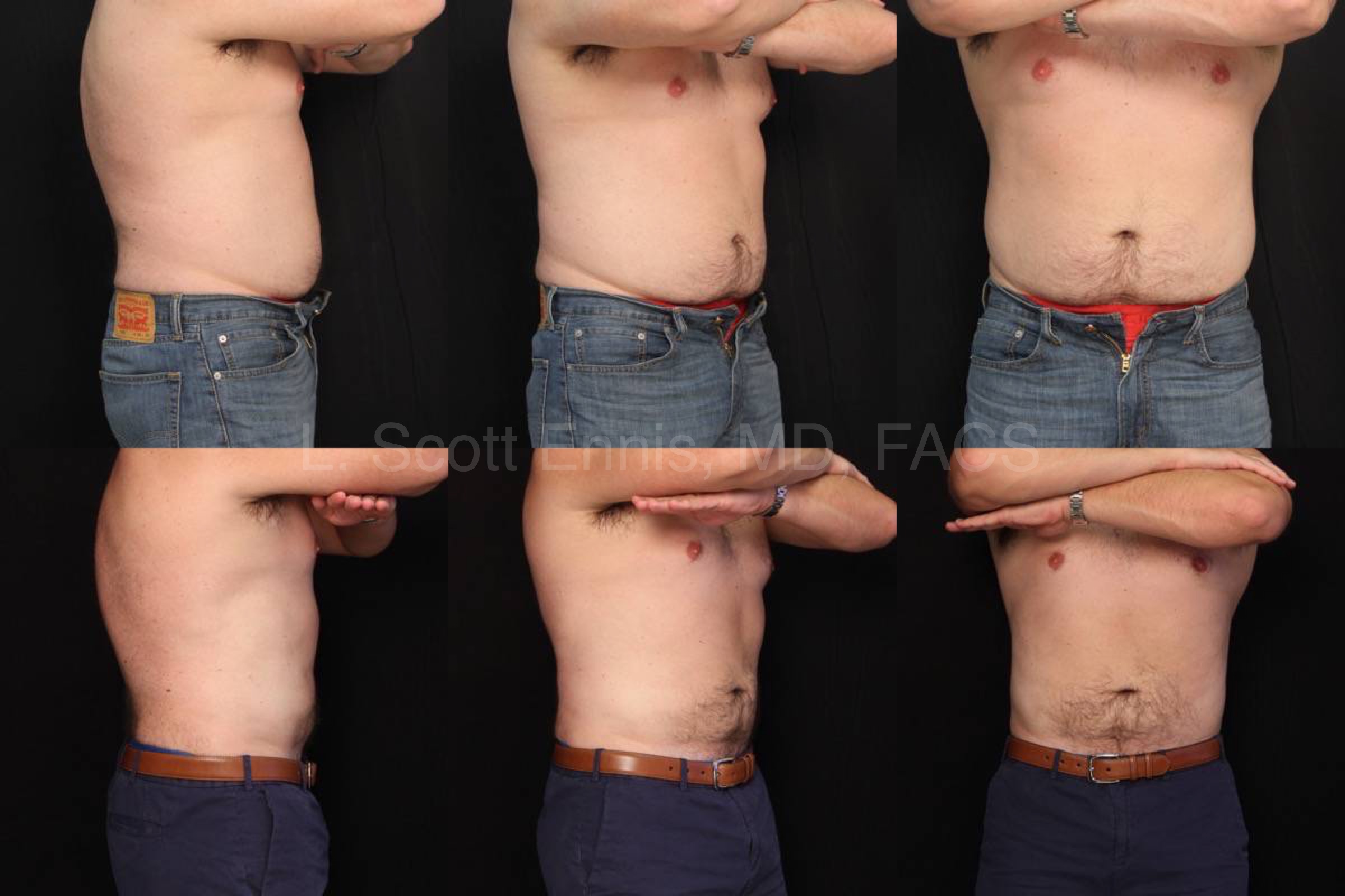 Liposuction of Abdomen_ Hips and Chest Before and After Ennis Plastic Surgery Palm Beach Boca Raton Destin Miami Fort Lauderdale