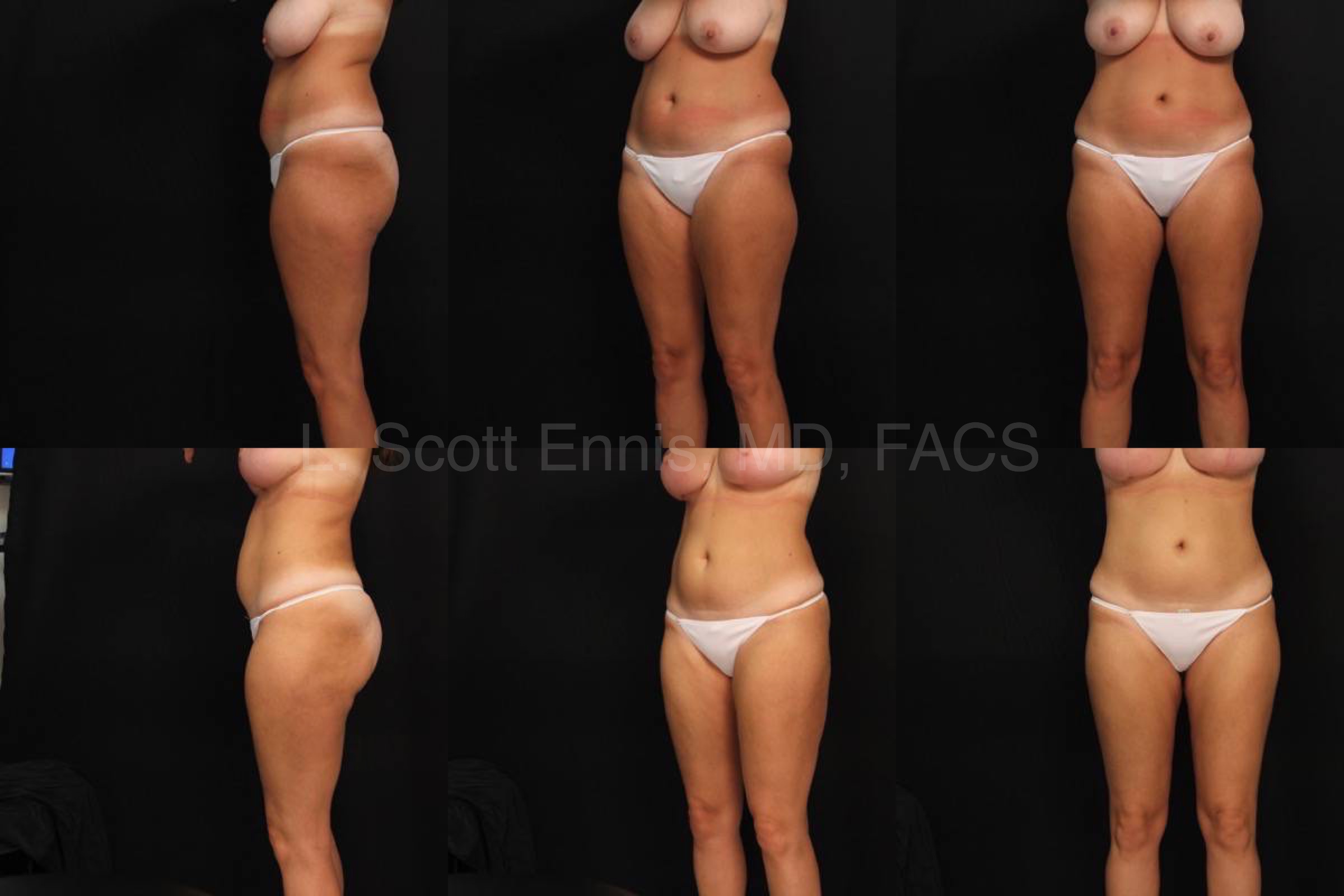Liposuction of Hips and Thighs 32yo 5_2_ 137lb Before and After Ennis Plastic Surgery Palm Beach Boca Raton Destin Miami