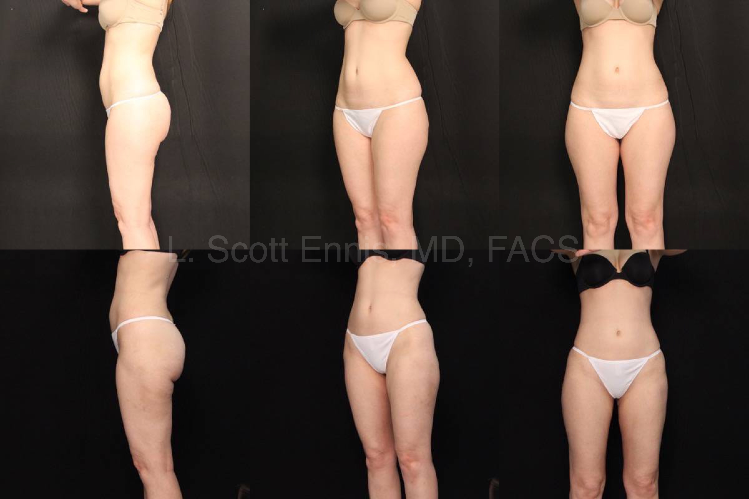 Liposuction of Hips and Thighs Before and After Ennis Plastic Surgery Palm Beach Boca Raton Destin Miami Fort Lauderdale