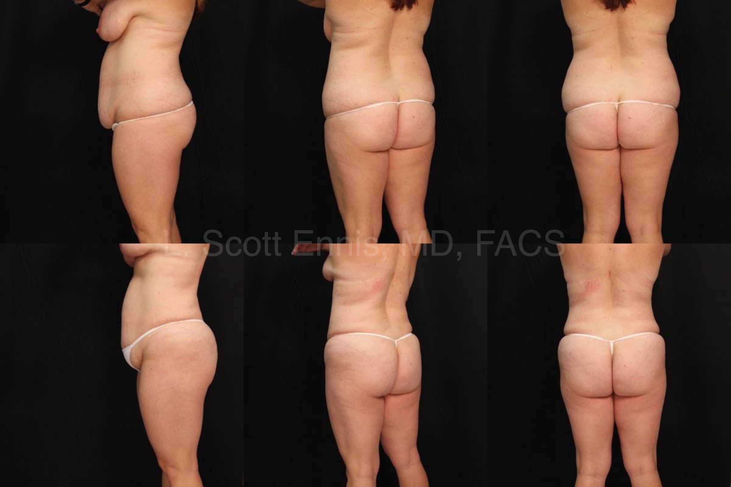 Liposuction of hips and breast reduction Before and After Ennis Plastic Surgery Palm Beach Boca Raton Destin Miami