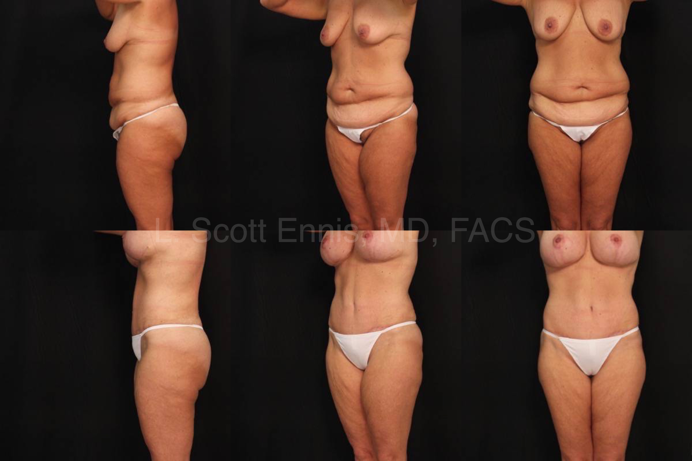 Mommy Make over Liposuction of hips_ abdominoplasty Mastopexy breast aug R500 L450 silicone Before and After Ennis Plastic Surgery Palm Beach Boca Raton Destin Miami Fort Lauderdale