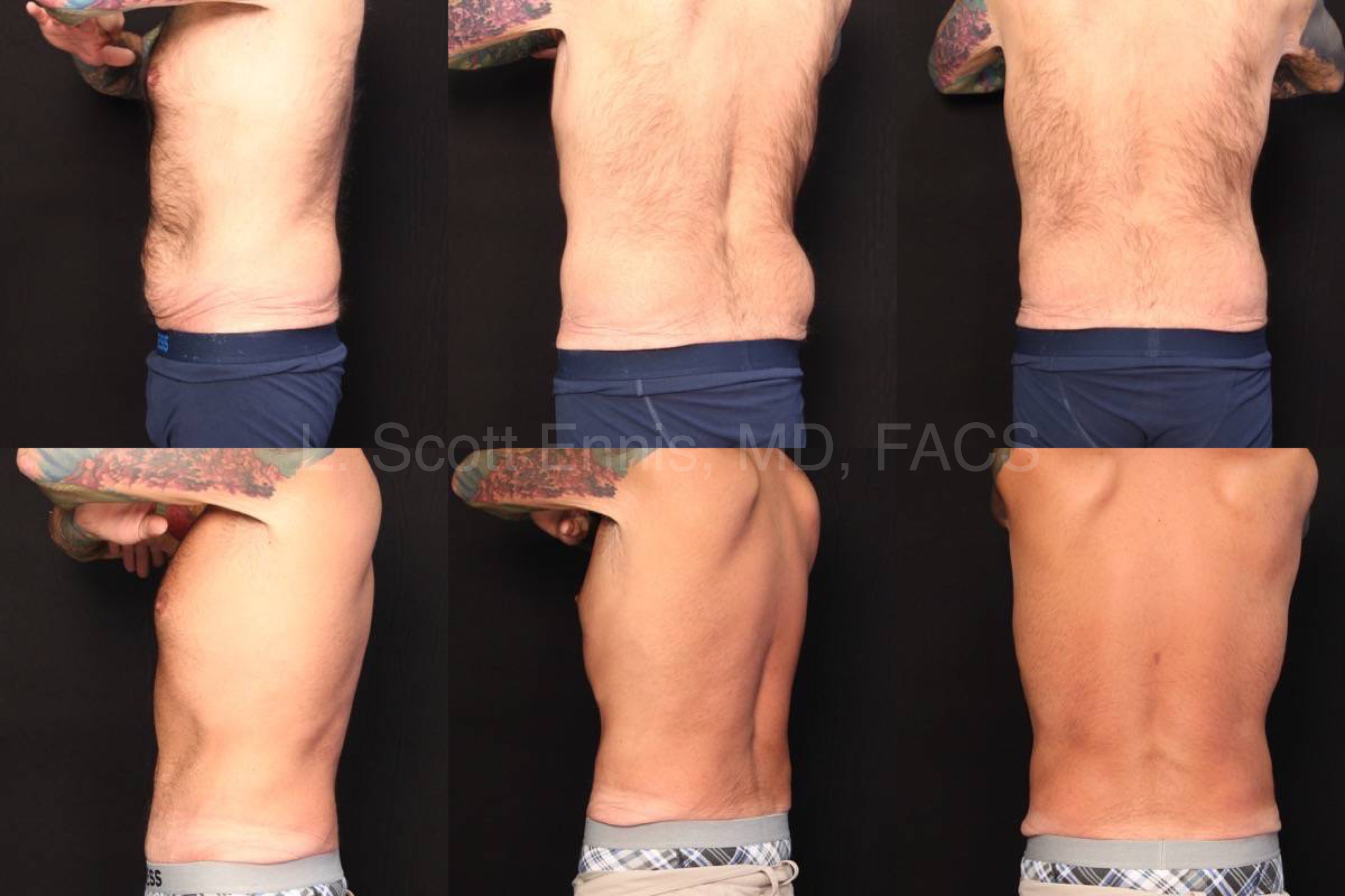 Male Abdominoplasty with Liposuction of Hips 44yo 5_11_ 174lb Before and After Ennis Plastic Surgery Palm Beach Boca Raton Destin Miami Fort Lauderdale