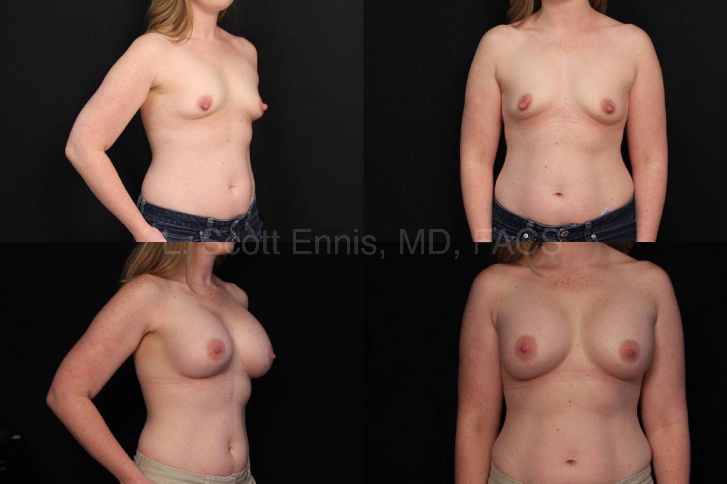 Nipple reduction with augmentation silicone gel implant Before and After Ennis Plastic Surgery Palm Beach Fort Lauderdale miami Boca Raton Destin Miami 40330