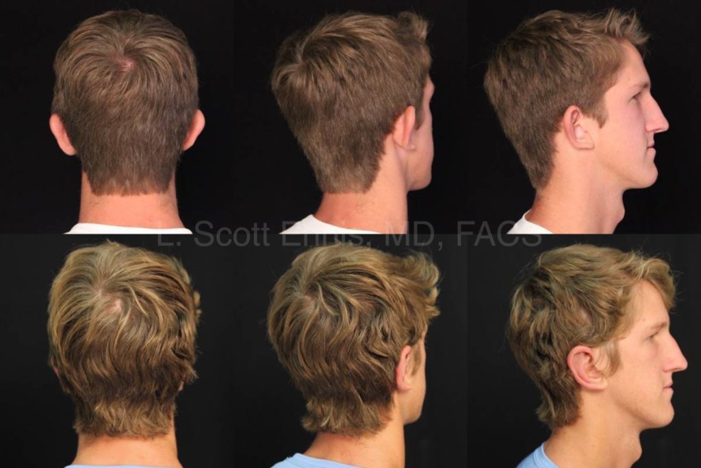Otoplasty 20yom Before and After Ennis Plastic Surgery Palm Beach Boca Raton Destin Miami 14078 back