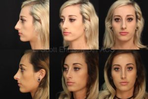 Rhinoplasty Ennis Plastic Surgery Palm Beach - Fort Lauderdale - Boca Raton Destin Miami