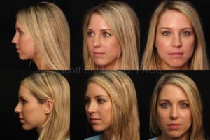 Rhinoplasty - correction of crooked nose Before and After Ennis Plastic Surgery Fort Lauderdale -Palm Beach Boca Raton Destin Miami 27198