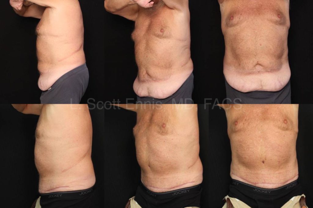 abdominoplasty 59 yo male Before and After Ennis Plastic Surgery Palm Beach Boca Raton Destin Miami 42395
