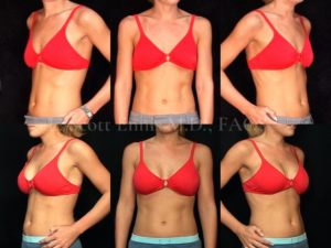 Most Natural Breast Augmentation: Round Implants or Teardrop? - Palms