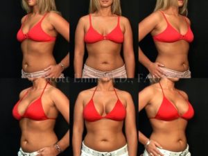 Gummy Bear Implants for Natural-Looking Breast Augmentation