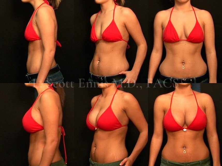 Before and After Ennis Plastic Surgery Palm Beach Boca Raton Destin Miami Fort Lauderdale Florida