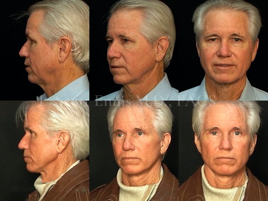 Male Facelift