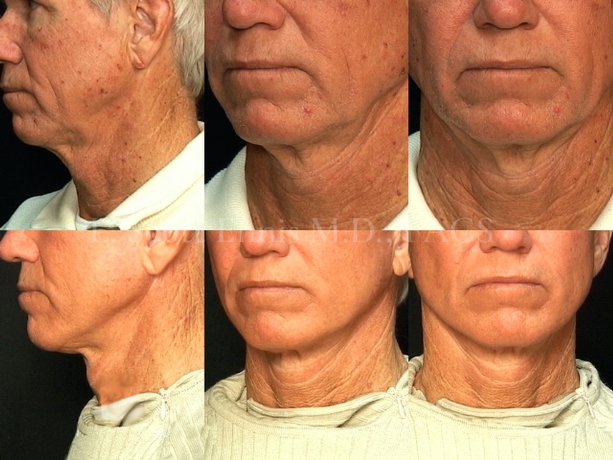 Male Facelift