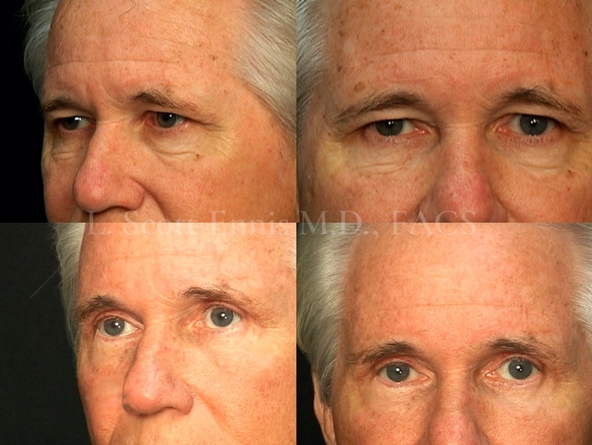 Male Facelift