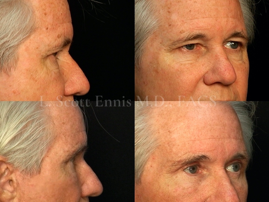 Male Facelift