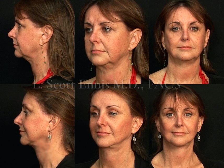 Before and After Ennis Plastic Surgery Palm Beach Boca Raton Destin Miami Fort Lauderdale Florida