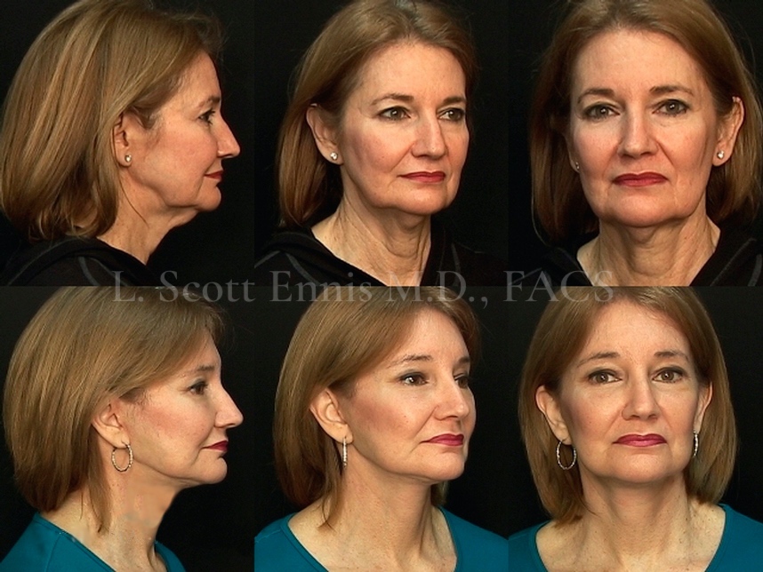 Before and After Ennis Plastic Surgery Palm Beach Boca Raton Destin Miami Fort Lauderdale Florida