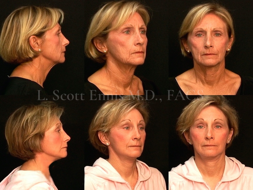 browlift-facelift-before-after-scott-ennis-md-destin-palm-beach-69e9fc (1)