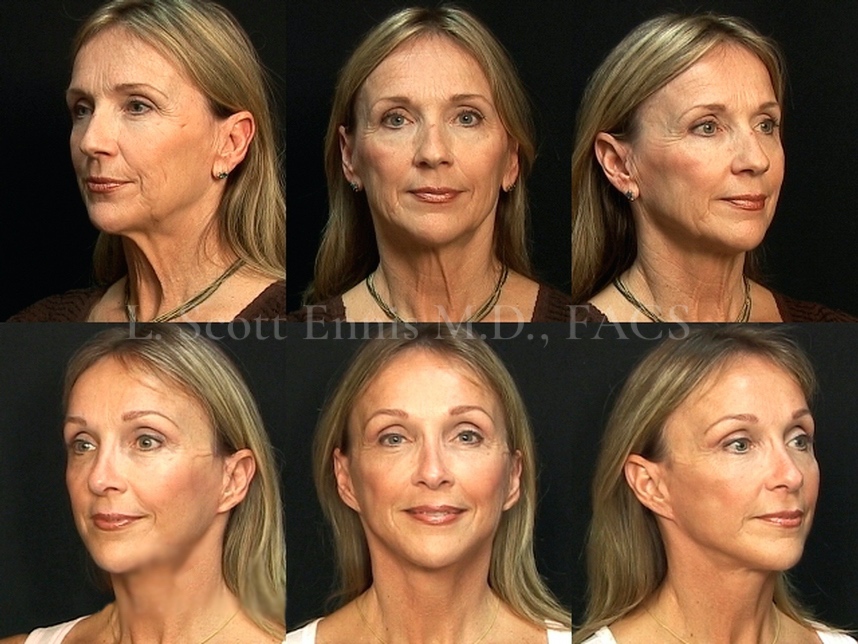 LIFTING FACIAL ( RITIDECTOMIA) – Stima