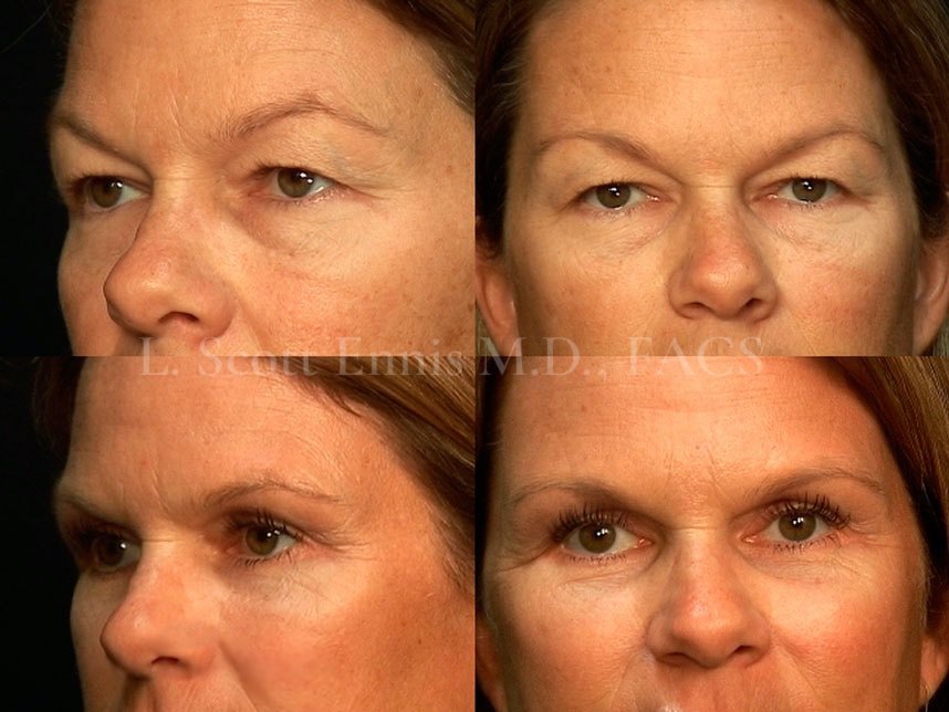 Blepharoplasty (eyelid surgery) Before and After