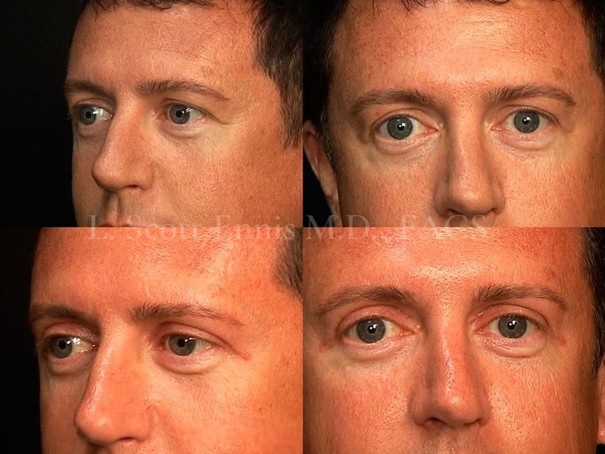 Before and After Ennis Plastic Surgery Palm Beach Boca Raton Destin Miami Fort Lauderdale Florida