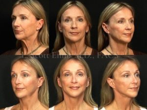 Before and After Ennis Plastic Surgery Palm Beach Boca Raton Destin Miami Fort Lauderdale Florida