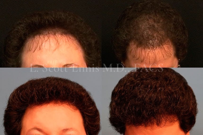 hair-transplant-before-after-scott-ennis-md-destin-palm-beach-313567d (2)