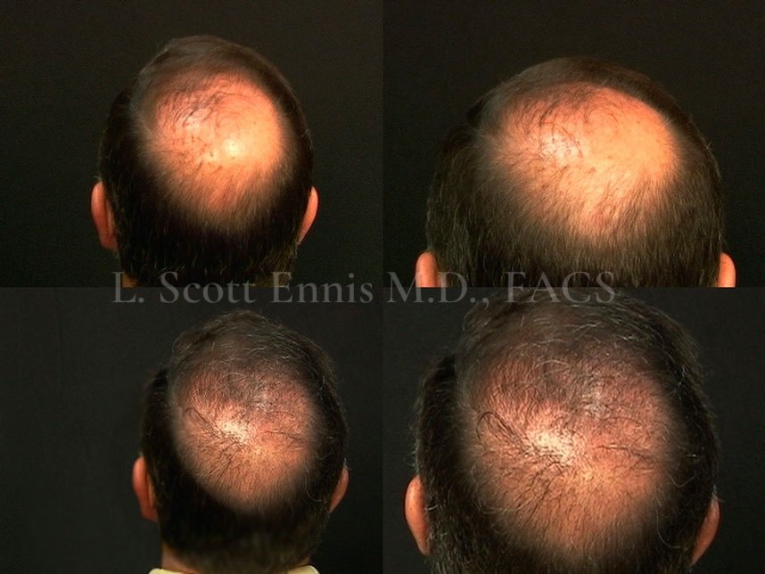 Hair Transplant with No Scar & Natural Looking Results | FUE Neograft 