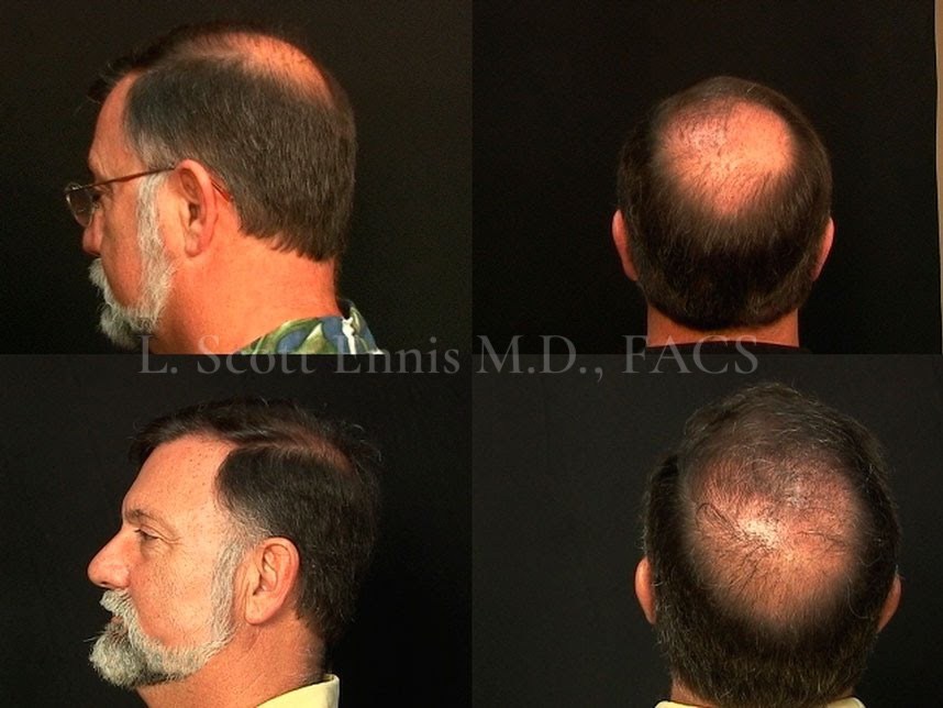 Hair Transplant / Restoration Before & After Photos | Ennis Plastic Surgery