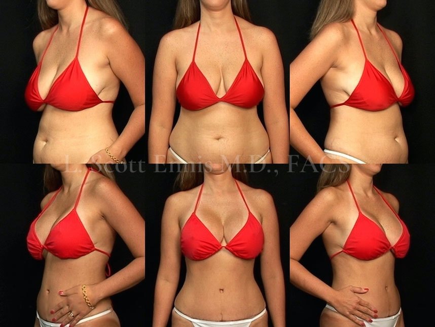 Breast Augmentation: What Types of Breast Implants Are There