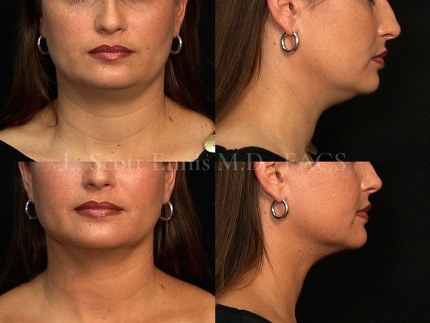 Neck Liposuction